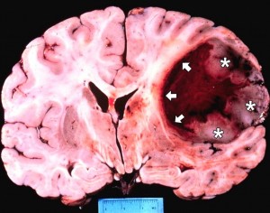 Glioblastoma-Multiforme-Brain-Tumor-Vaccine-1024x805
