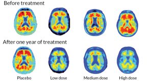 083116_ls_alzheimers_main