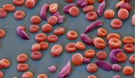 小分子鐮刀細(xì)胞疾病藥物上市 小分子鐮刀細(xì)胞疾病藥物上市